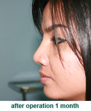 plastic_surgery_augmentation_rhinoplasty